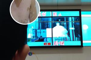 適合兒童色素脫失癥患者有哪些治療方法