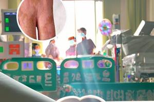 手上白斑照射308一般多大劑量合適