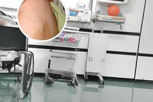 嘴唇白斑用308好嗎還是激光