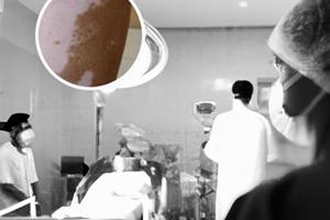 308光線光療對眼睛有害嗎知乎